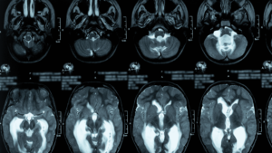 Hidrocefalia | Dra. Carolina Alvarez | Neurologista