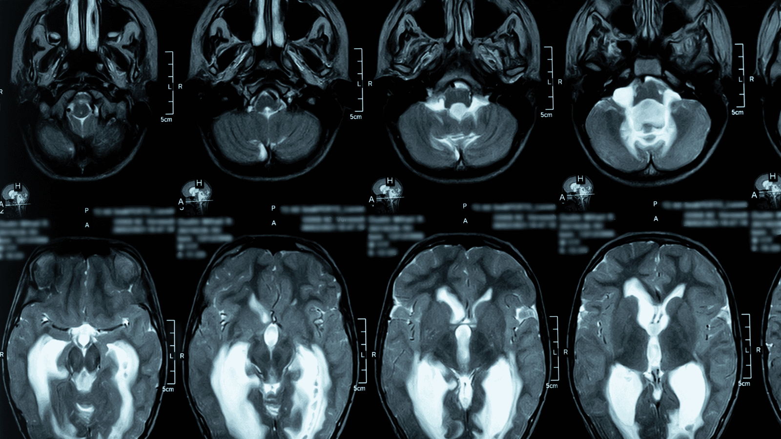 Hidrocefalia | Dra. Carolina Alvarez | Neurologista