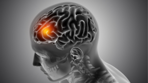 Doenças neuromusculares | Dra. Carolina Alvarez