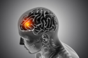 AVC — Acidente Vascular Cerebral: Sinais de Alerta e Como Agir