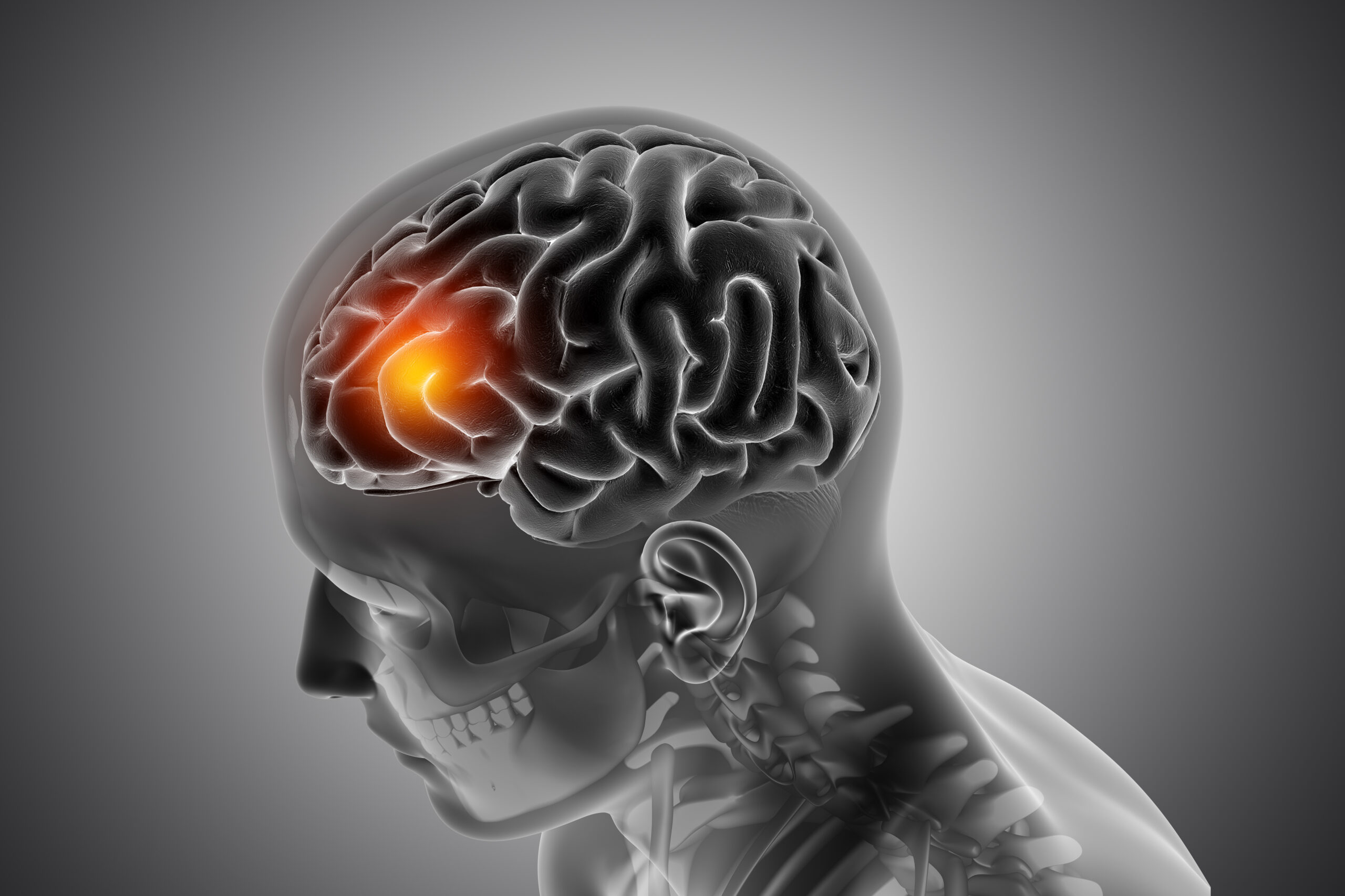 Ataxia Cerebelar: 7 Sintomas, Causas e Tratamento Neurológico
