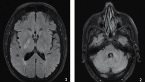 Vasculite do Sistema Nervoso Central: 6 Sintomas, Diagnóstico e Tratamento