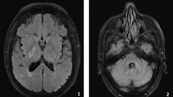 Vasculite do Sistema Nervoso Central: 6 Sintomas, Diagnóstico e Tratamento