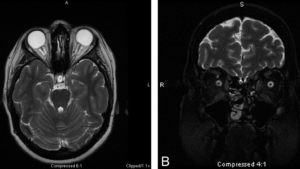 Pseudotumor Cerebri: 6 Sintomas, Diagnóstico e Tratamento Neurológico