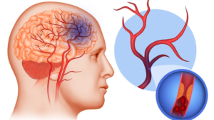 Trombose Venosa Cerebral: 6 Sintomas, Causas e Tratamento